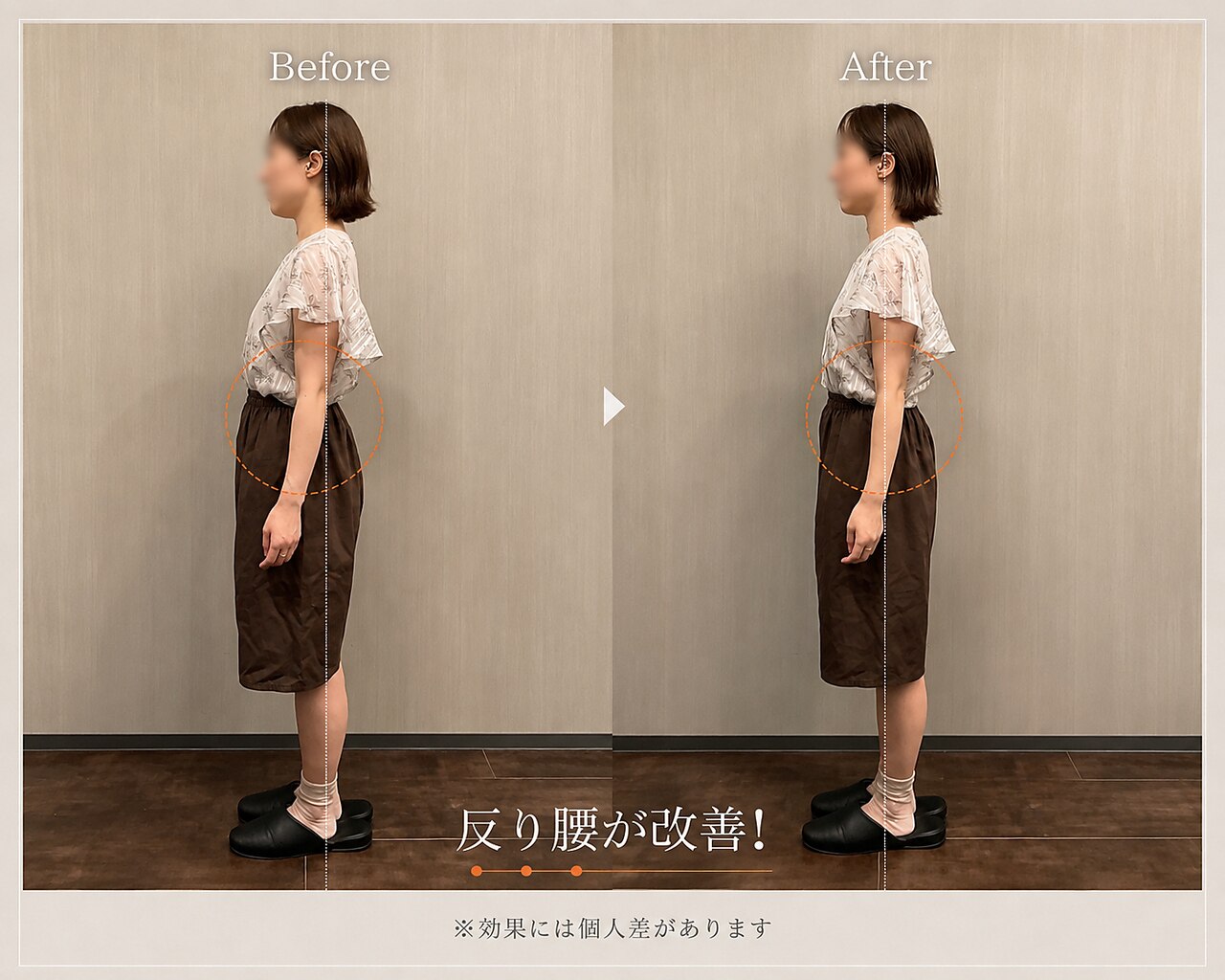 反り腰の施術前後の比較写真